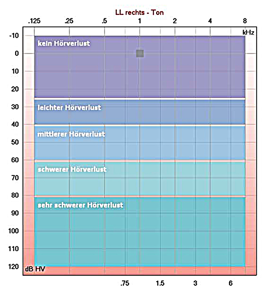 Ton Audiometrie: Hörschwelle (HS) / Hörverlust (HV)