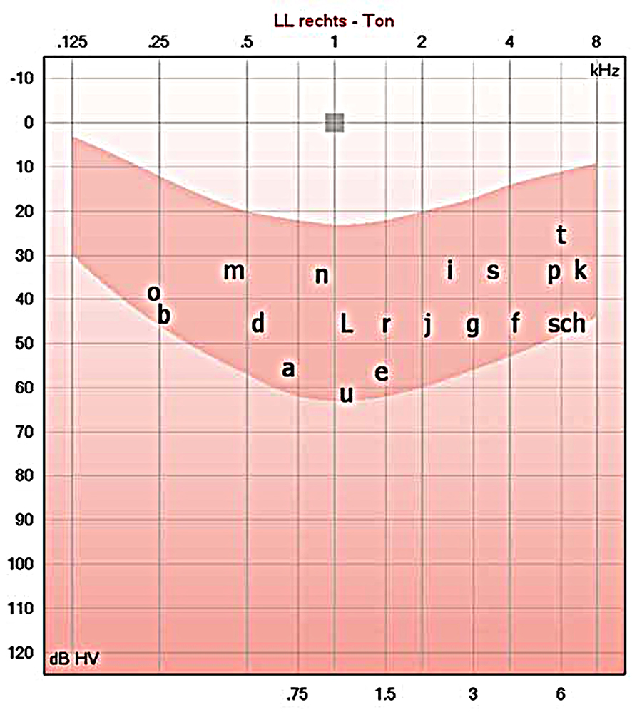 Abbildung - Ton Audiometrie: die Sprachbanane im Ton-Audiogramm