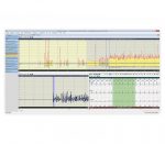 Amedtec EP8 Langzeit-EKG – Bildschirmansicht Schnelle Detektion von VH-Arrhythmien